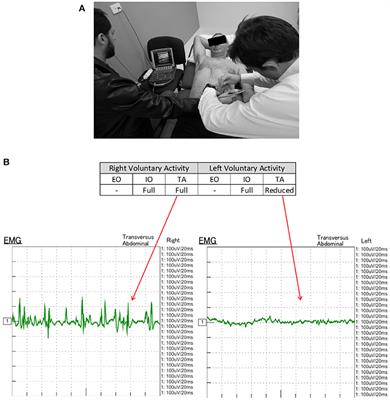 Limitations of Electromyography in the Assessment of Abdominal Wall Muscle Contractility Following Botulinum Toxin A Injection